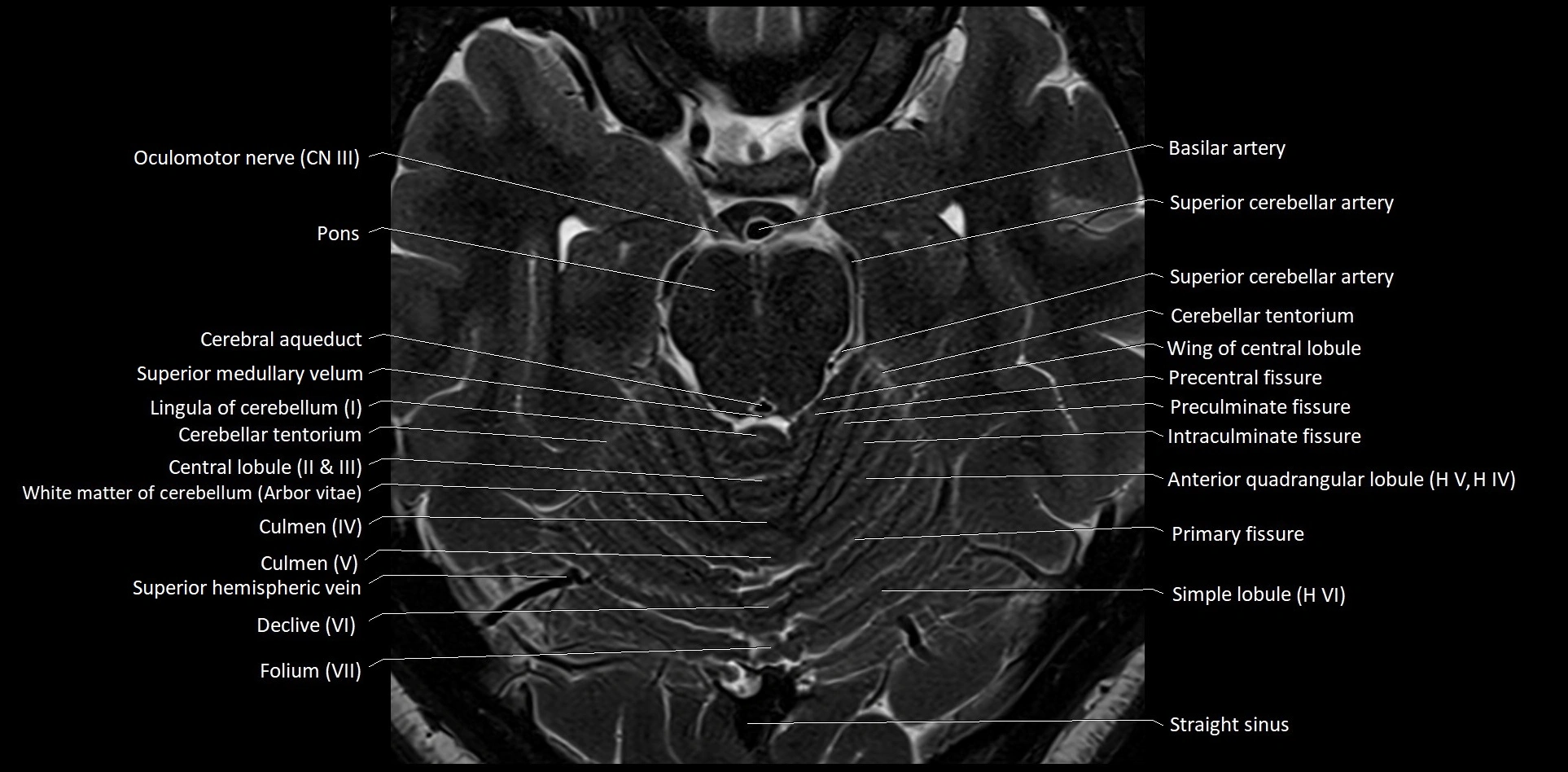 MRI Cerebellar anatomy High-resolution labelled 3T MRI image 21.webp